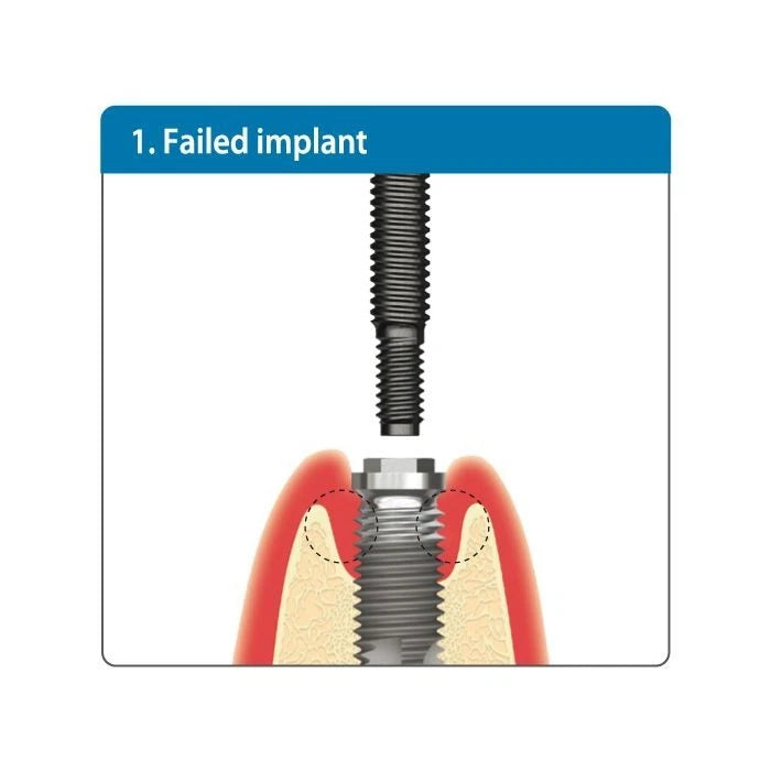 Universal Implant Fixture Removal Kit FR Screw Remover Tool Neobiotech Style