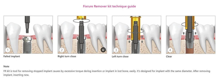 Universal Implant Fixture Removal Kit FR Screw Remover Tool Neobiotech Style